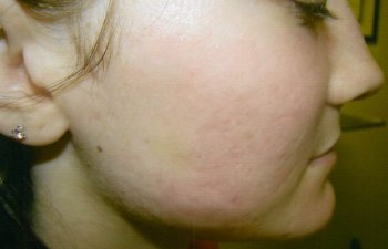 Patient After PSR / Portrait Resurfacing