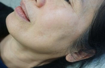 Female Patient After Pico Genesis Laser Procedure