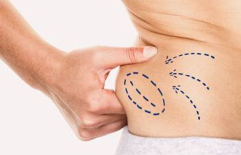 Woman with pre-liposuction marking squeezing fat tissue on her waist.