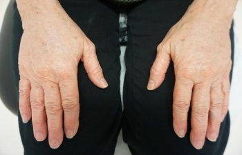 hands after Radiesse procedure