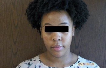 female patient after chemical peel procedure