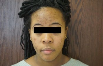 female patient before chemical peel procedure