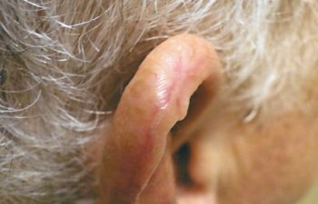 patient after mohs ear procedure